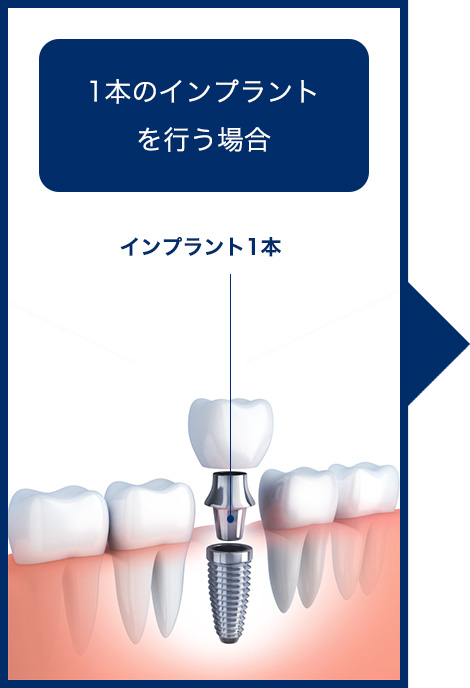 1本のインプラントを行う場合