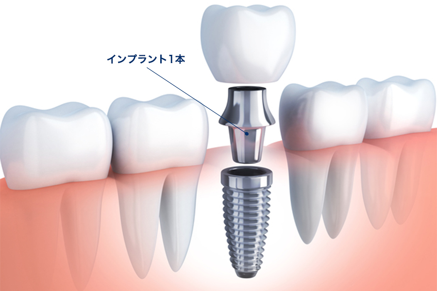 1本のインプラントを行う場合