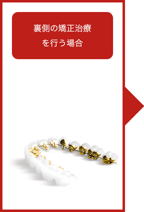 裏側の目立たない矯正治療を行う場合