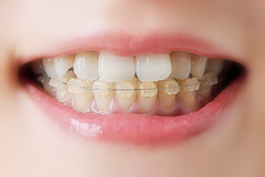 1本のインプラントを行う場合