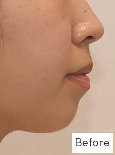 ボツリヌス術前