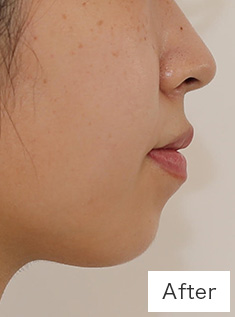 ボツリヌス術後