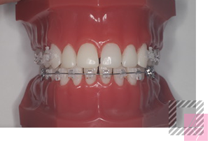 クゥオーターライン矯正治療